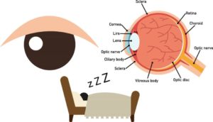 Sleep Apnea and Glaucoma